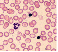 Beta thalassemia cells.