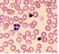 beta thalassemia